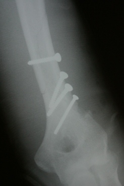Elbow With Pins After Surgery