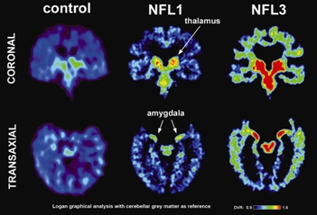 PET scans showing tau protein in retired NFL players