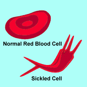 Normal red blood cell versus sickle cell 