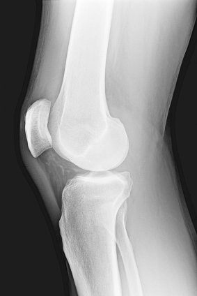 X-ray of the knee